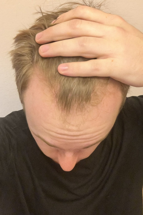 hair growth hair loss progress results