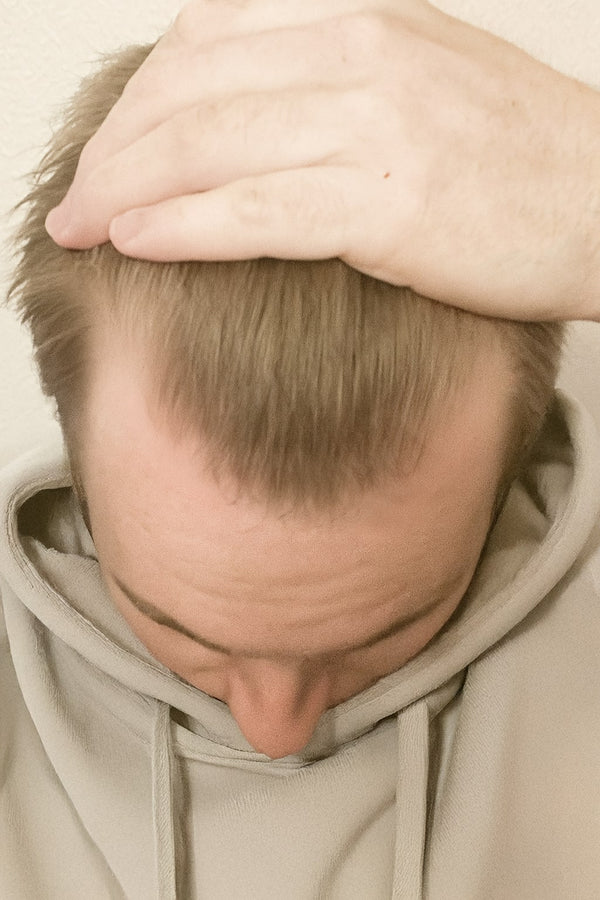 hair growth hair loss progress results