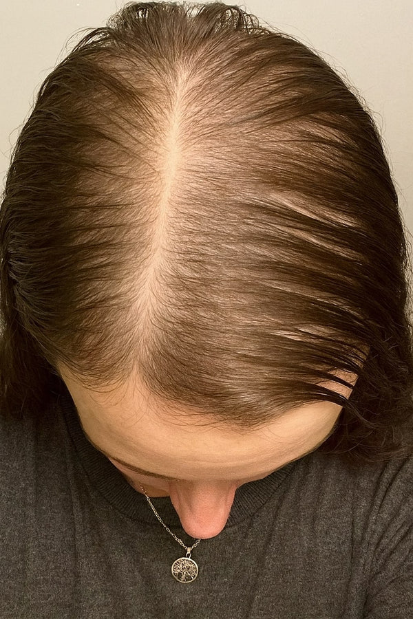 hair growth hair loss progress results