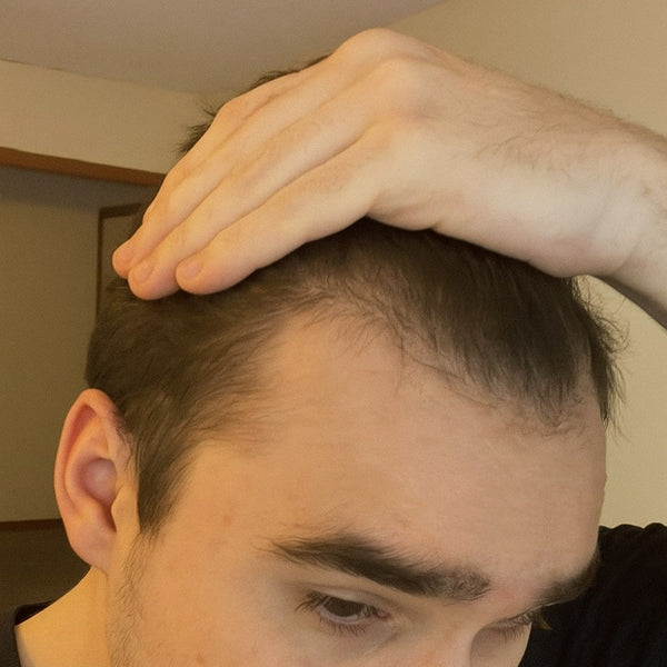 hair growth hair loss progress results