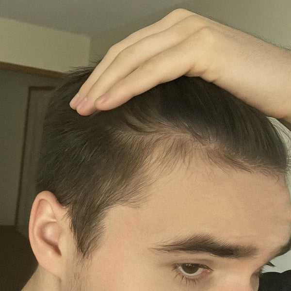hair growth hair loss progress results