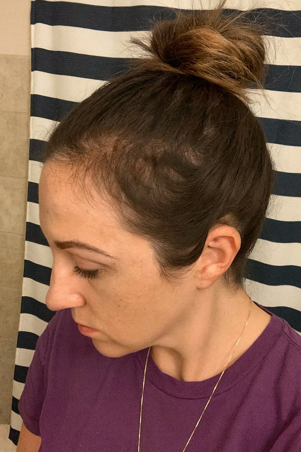 hair growth hair loss progress results