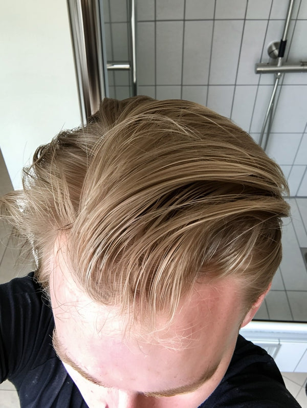 hair growth hair loss progress results