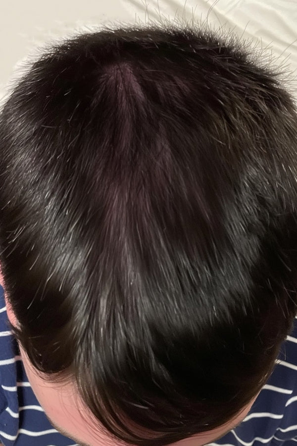 hair growth hair loss progress results