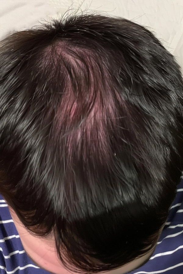 hair growth hair loss progress results